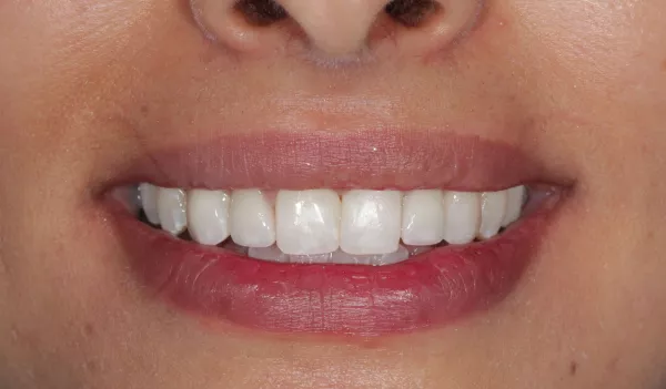 After 3 Natural Veneers