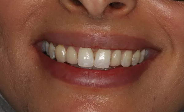 Before 3 Natural Veneers