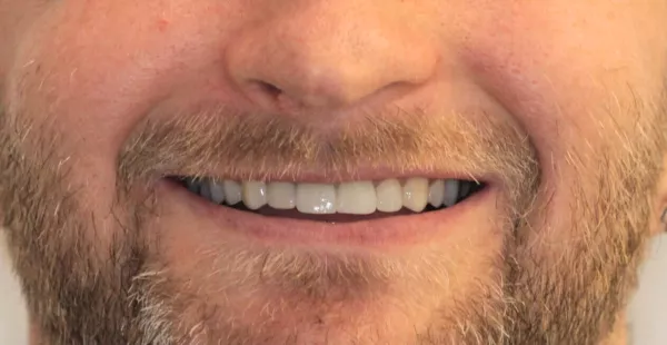 After 8 Porcelain Veneers