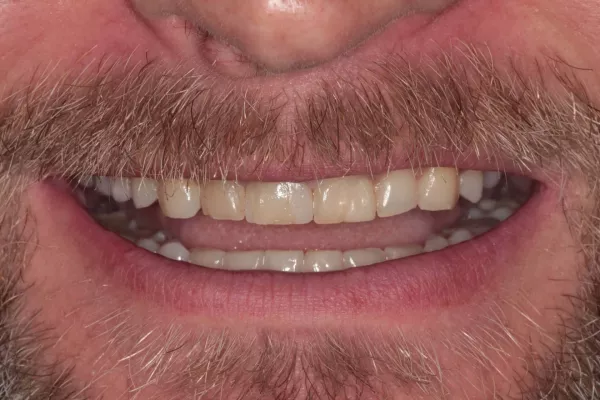Before 8 Porcelain Veneers