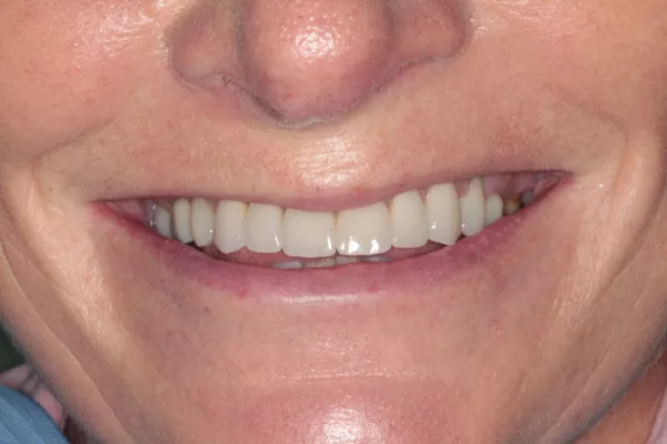 After Crowns and veneers