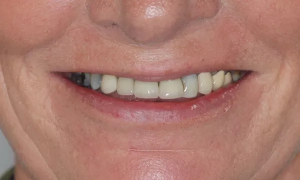 Before Crowns and veneers