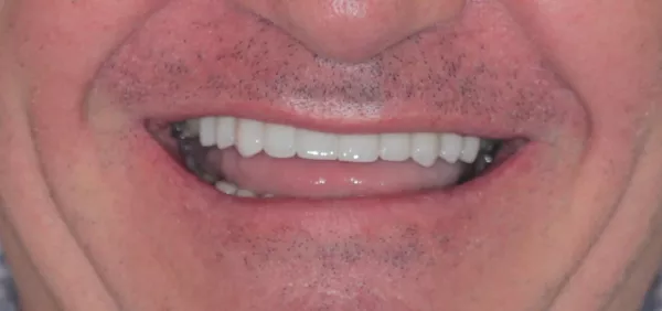 After Emax veneers
