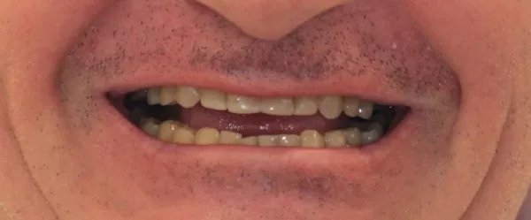 Before Emax veneers