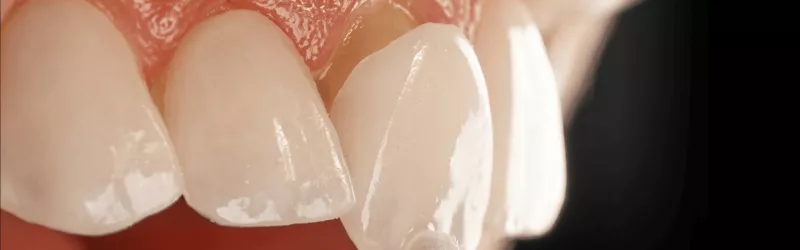 Porcelain Veneers Background (Mobile)